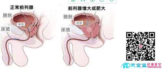 經(jīng)尿道前列腺等離子雙極電切術(shù)動(dòng)畫(huà)視頻d.jpg