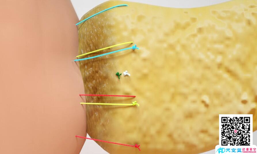 三維3d動畫演示胰十二指腸切除術(shù)6.jpg