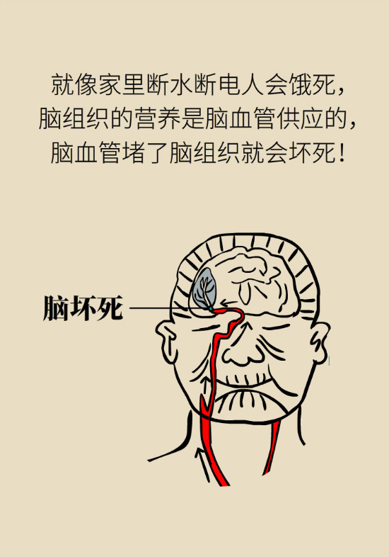 腔隙性腦梗死一定是腦血管堵了嗎？