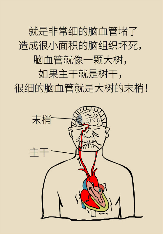 腔隙性腦梗死一定是腦血管堵了嗎？