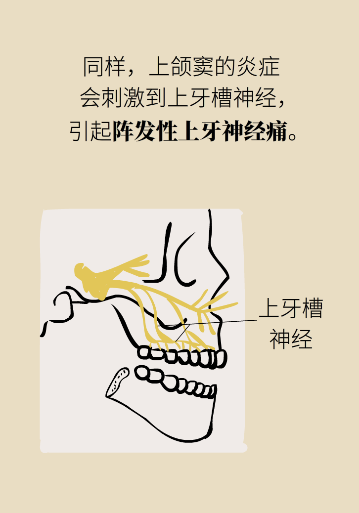 為什么鼻竇發(fā)炎，疼的卻是頭、眼和牙？