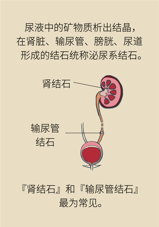 結(jié)石科普：身體里多了各種結(jié)石，應(yīng)該怎么辦？