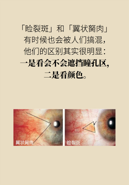 眼白有斑塊、出血要緊嗎？專家：名字唬人但問題不大