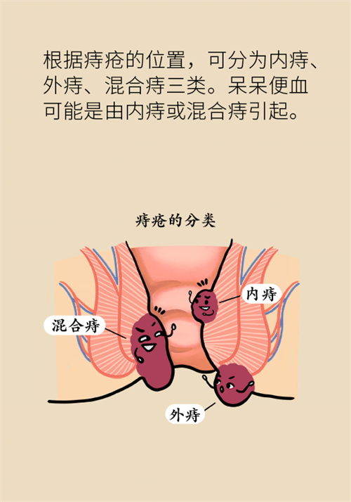 肛門腫脹還有血？小心痔瘡找上門