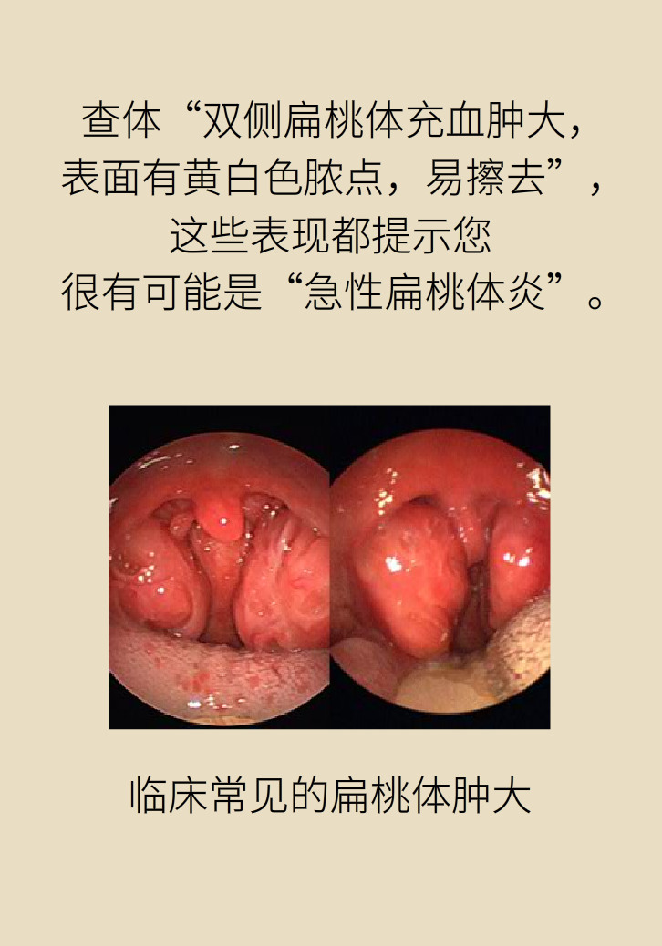 單側(cè)扁桃體腫大更兇險(xiǎn)！謹(jǐn)防惡性腫瘤