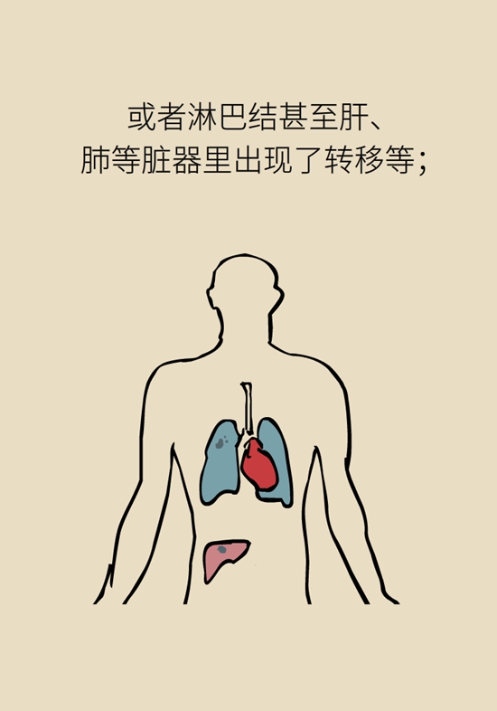 乳腺癌復發(fā)、轉移了怎么辦？